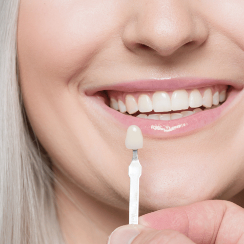 Veneers – die unkomplizierte Lösung für schöne Zähne