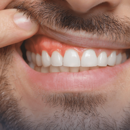 Zahnfleischtaschen: Definition und Messung