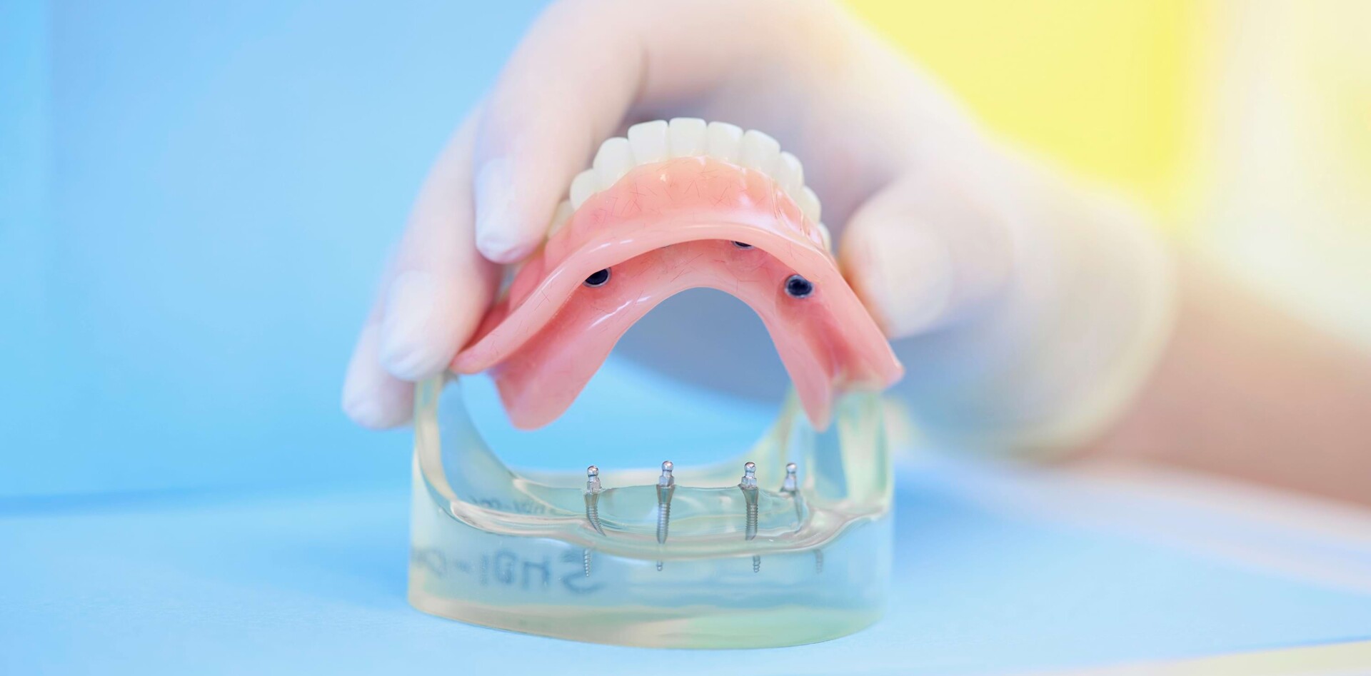Zahnersatz auf Implantaten als Vollversorgung