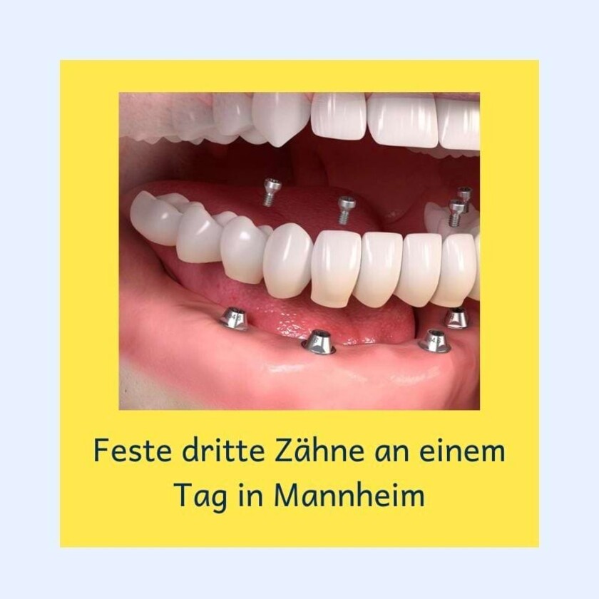 Feste dritte Zähne an einem Tag in Mannheim