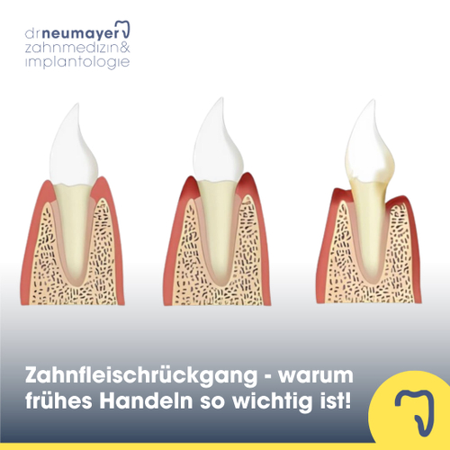 Zahnfleischrückgang:  Ursachen, Behandlung und warum frühes Handeln so wichtig ist