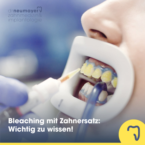 Bleaching mit Zahnersatz | Zahnarzt Dr. Neumayer in Mannheim