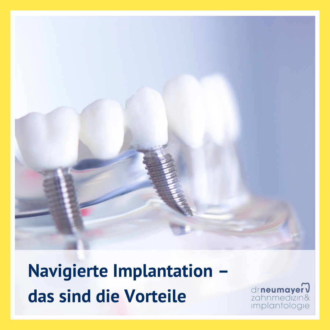 Navigierte Implantation