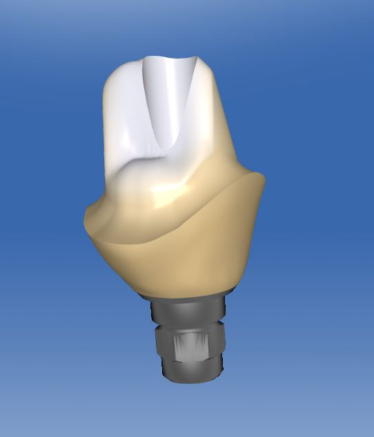 CAD Entwurf eines CEREC Abutments