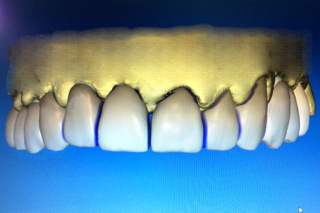 CEREC Design