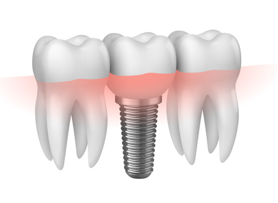 Implantat schematisch