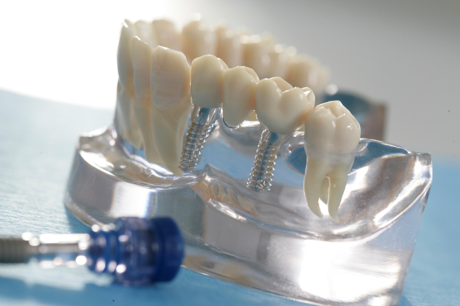 Implantat getragener Zahnersatz | Quelle: Initiative proDente