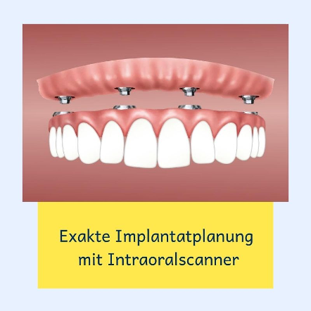 Exakte Implantatplanung 