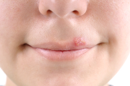 Lippenherpes